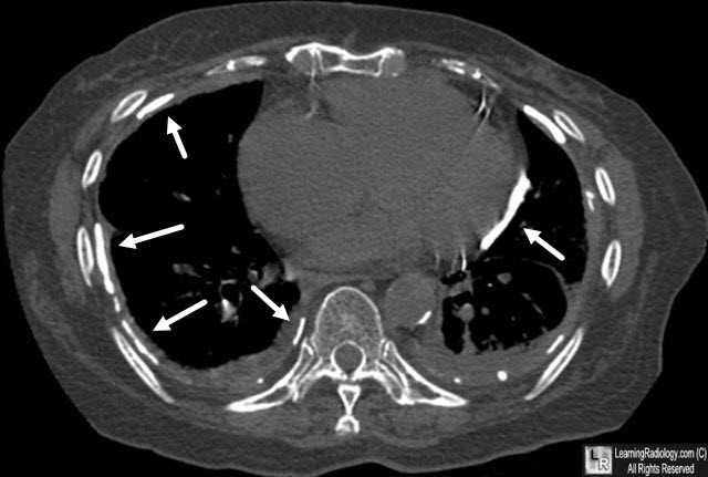 Asbestos-Related Pleural Disease